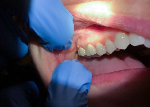 Best Emergency Denture Repair in Palm Springs, FL
